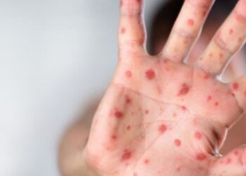 Ministerul Sănătăţii a declarat epidemie de rujeolă la nivel naţional. Aproape 2.000 de cazuri, în 29 de judeţe