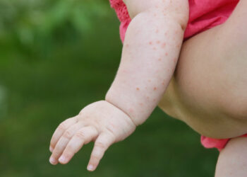 Un bebeluş de 7 luni diagnosticat cu rujeolă a decedat